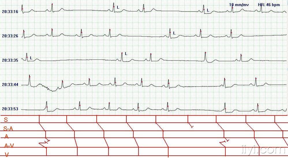 我的診斷:竇性心律,竇房阻滯(ii度-高度)或/和竇性停搏,交界性逸搏