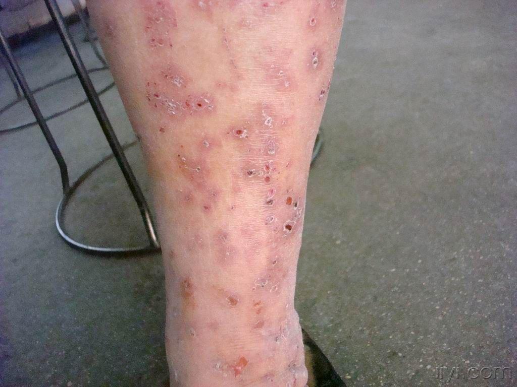 看图诊断27老年水痘