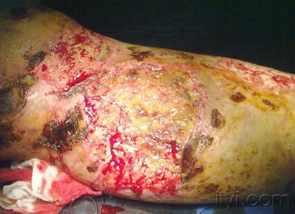 膝关节前侧皮肤坏死如何处理?