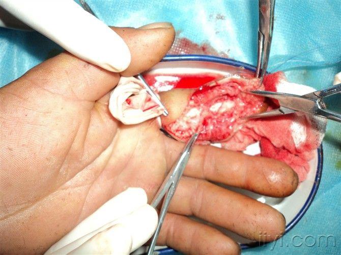 急性化脓性腱鞘炎图片图片