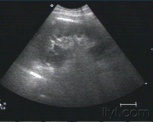 肾挫裂伤 - 超声医学讨论版 - 爱爱医医学论坛