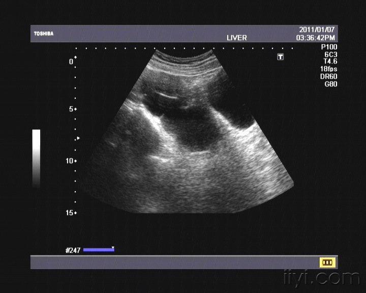 输卵管积水 - 超声医学讨论版 - 爱爱医医学论坛