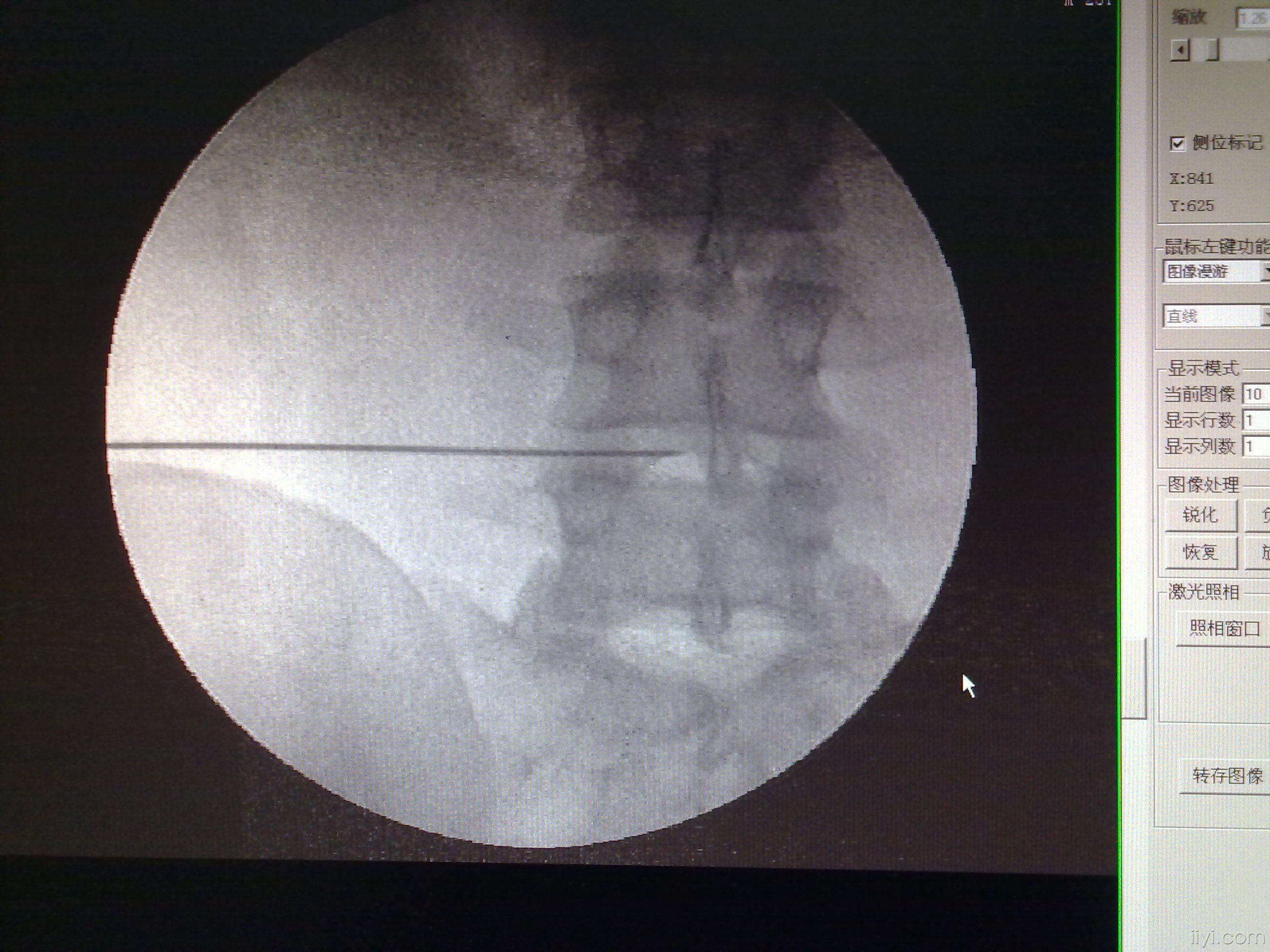 射频 治疗腰椎间盘突出症 过程 真实图片