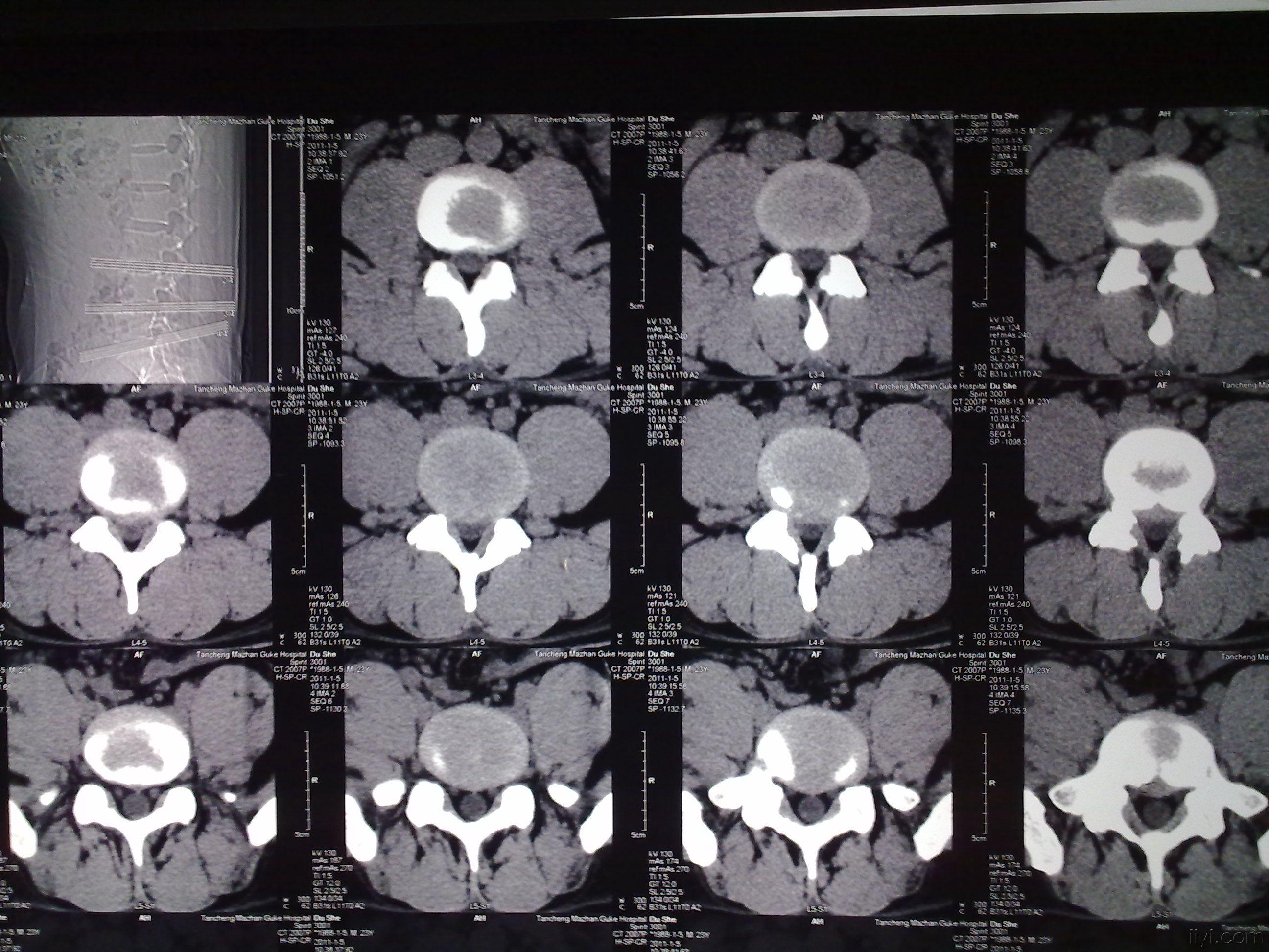 腰椎间盘突出ct图图片