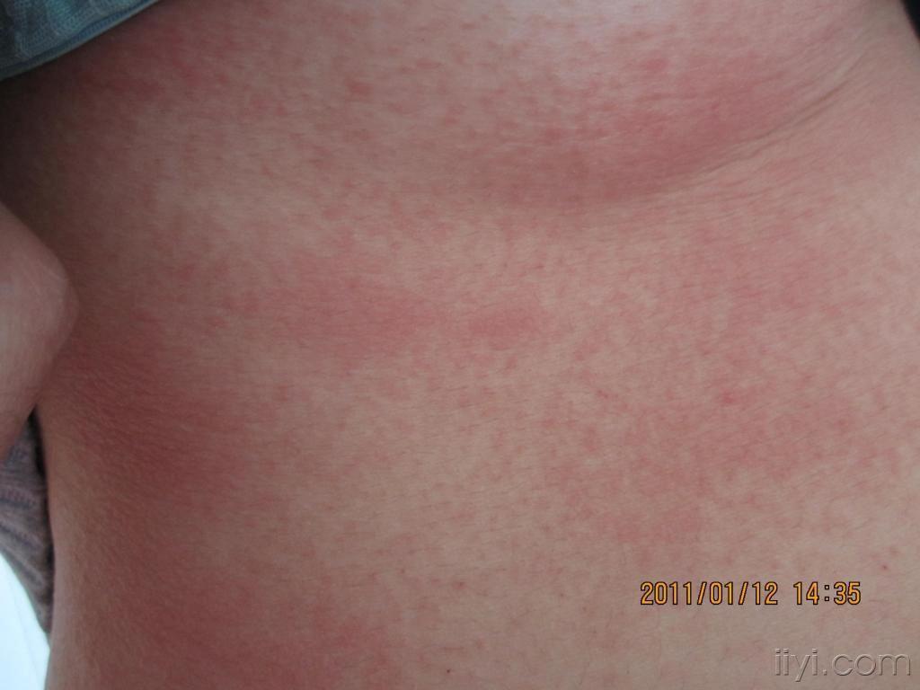 (图片超过100k,良版已修改,下次注意) - 皮肤及性传播疾病讨论版