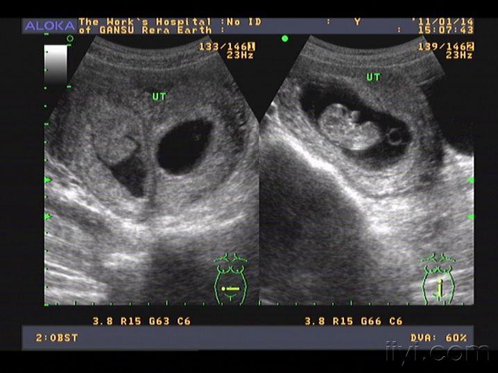 两个妊娠囊图片图片