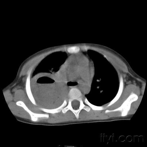 肺脓肿ct影像表现图片