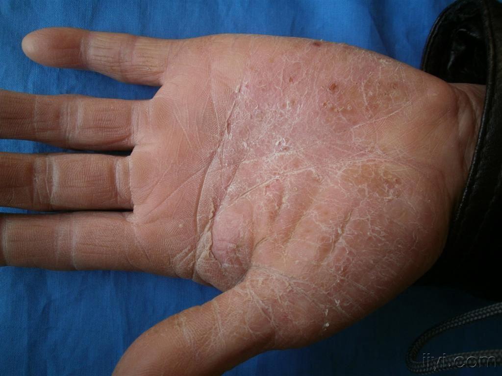 掌跖脓疱病的治疗讨论