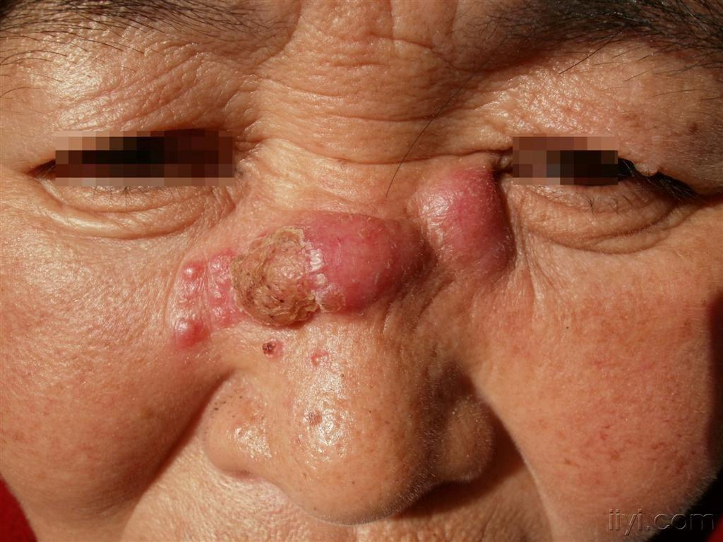 最近就诊的多例孢子丝菌病