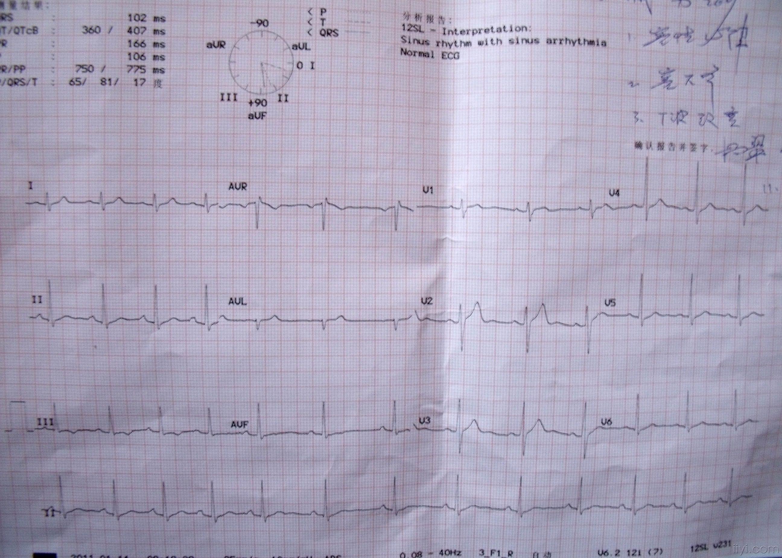 求助:体检做的心电图,t波改变,是不是传说中的2点半综合症