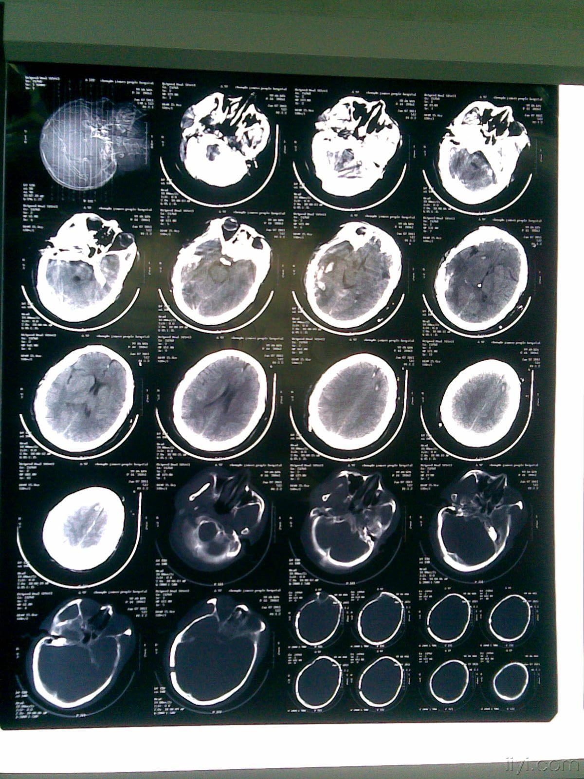 车祸致意识障碍伴头部出血1小时