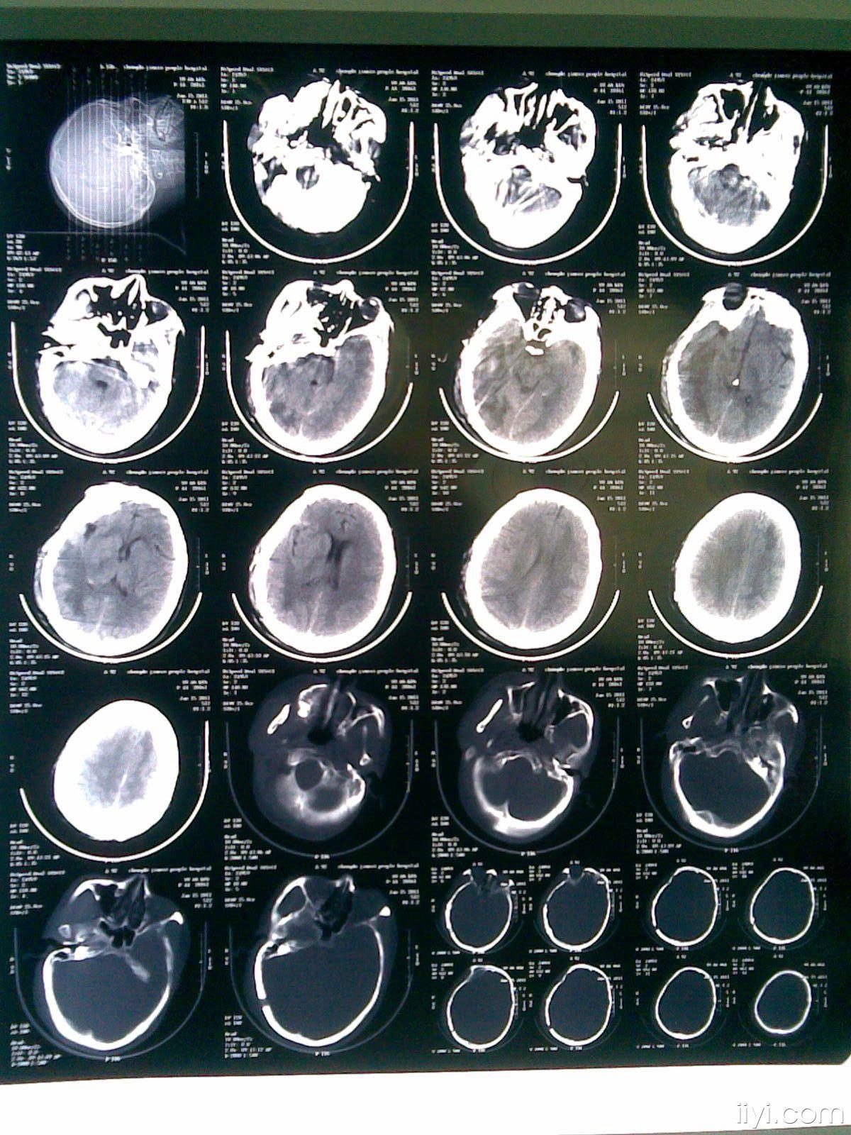 车祸致意识障碍伴头部出血1小时