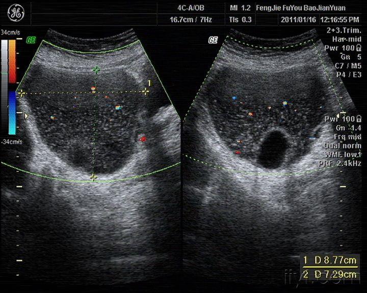 卵巢畸胎瘤超声图像图片