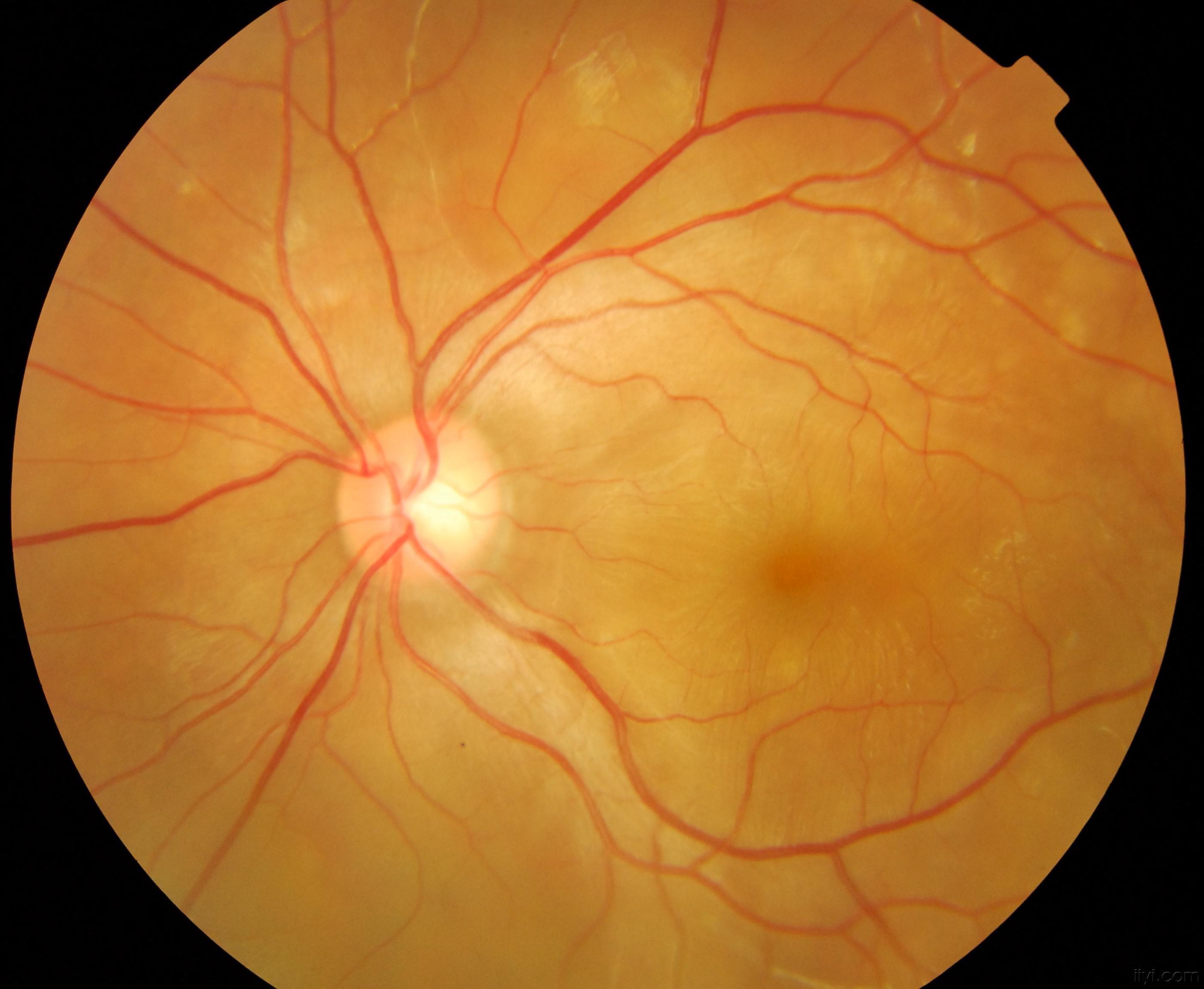 版 69 请教眼底问题  患者男,22岁,司机,以左眼晨起后视力下降3天