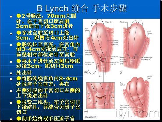 子宫海曼缝合术图片