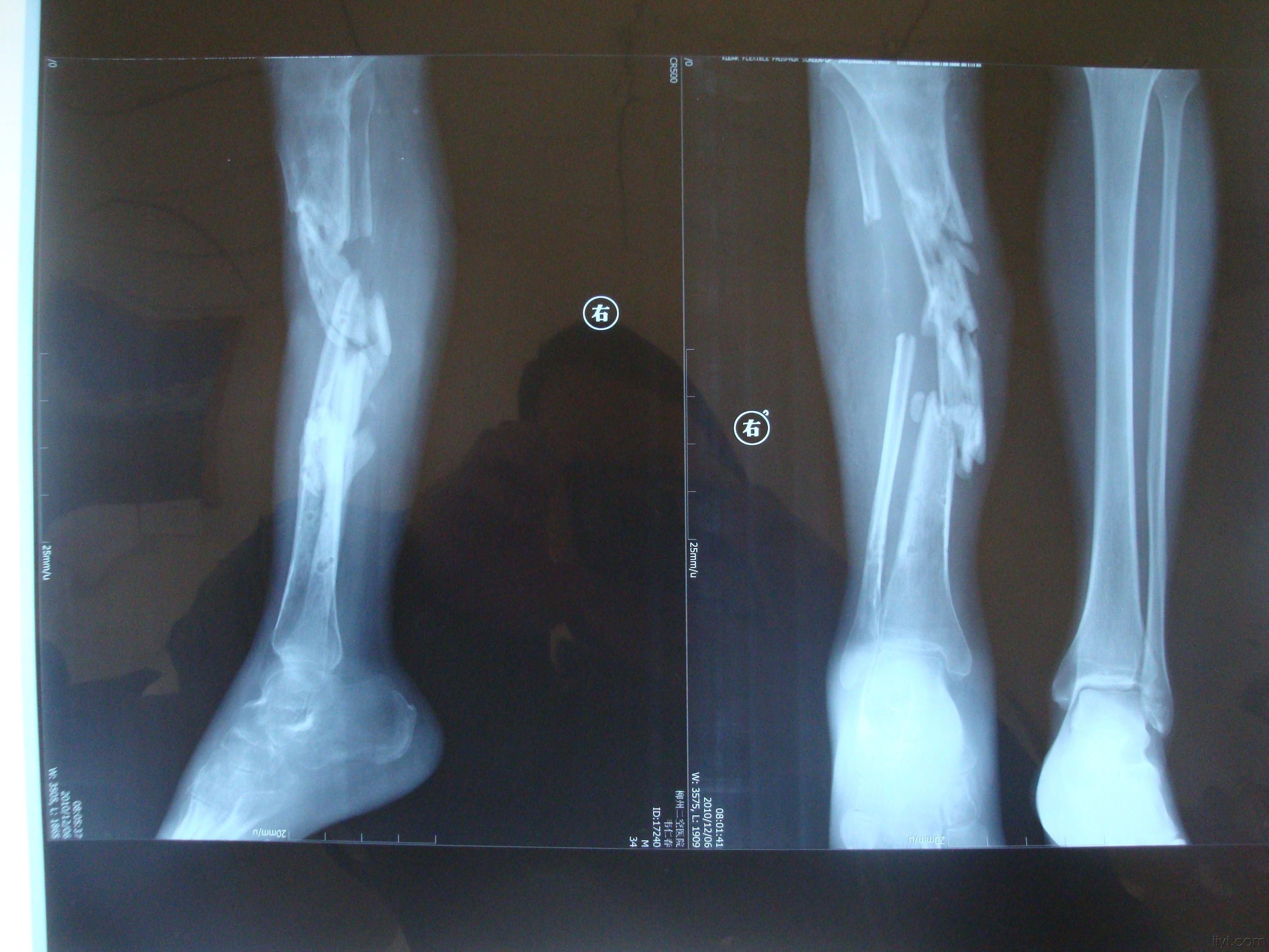 开放性骨折术后骨不连,骨髓炎