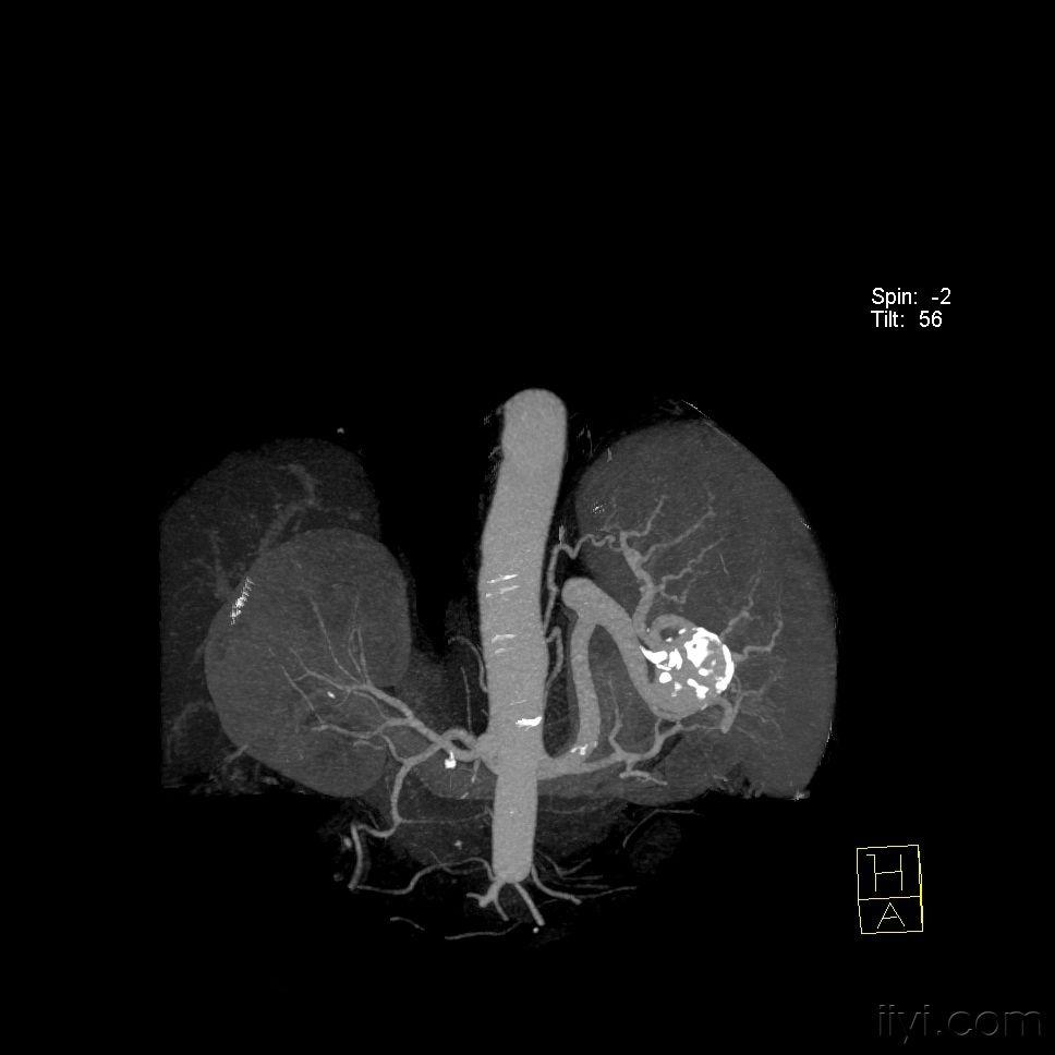 典型脾脏动脉瘤三维重建