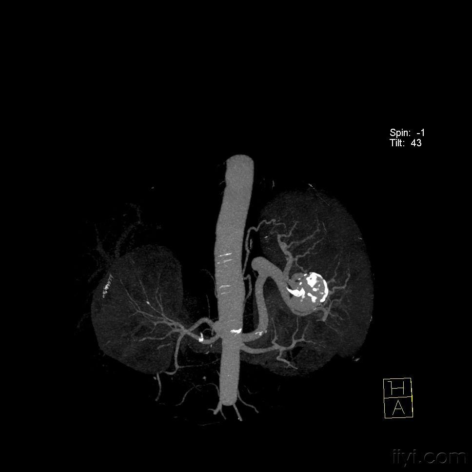 脾动脉ct图片