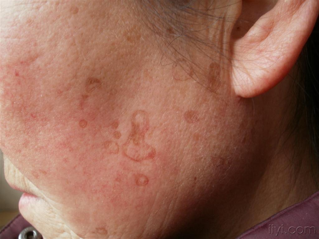 典型病例一天后公布答案(汗孔角化症)