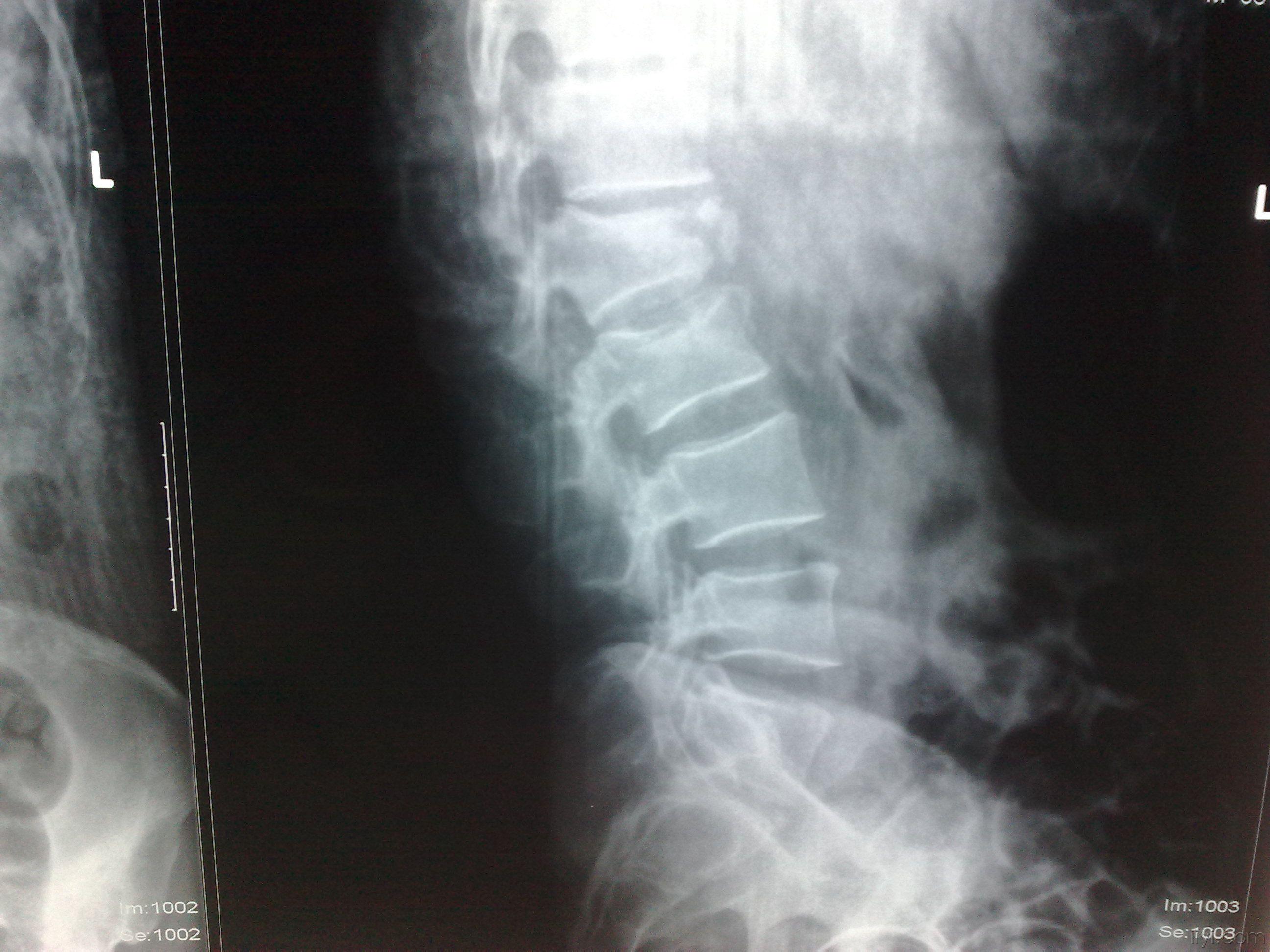 腰椎横突骨折图片 搜狗图片搜索