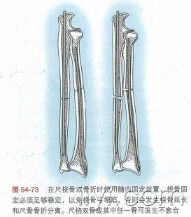 常見尺橈骨雙骨折的治療方案討論