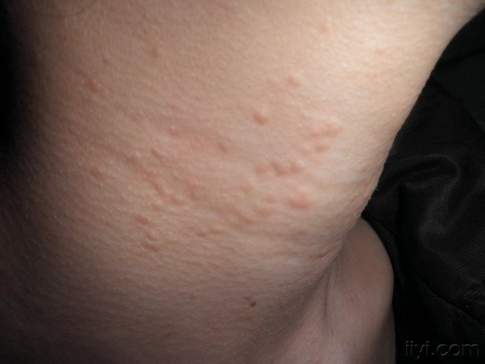 系列皮肤病发疹性汗管瘤