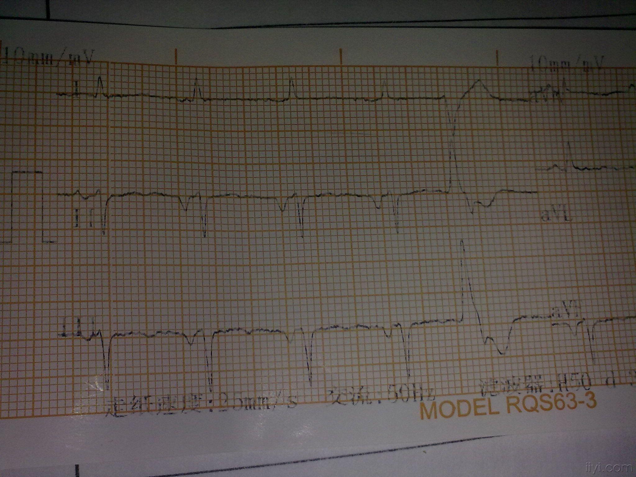 大家看看这个ecg,倒置p波 - 心电图脑电图专业讨论版 - 爱爱医医学