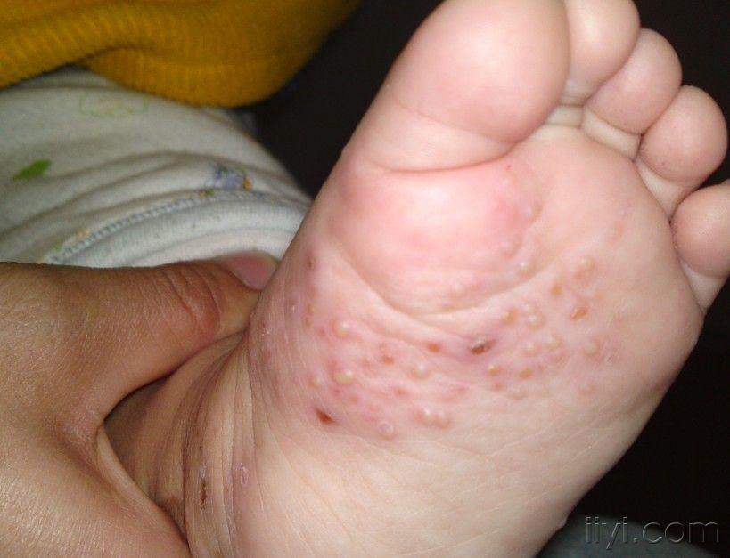 婴儿水泡型疱疹图片图片