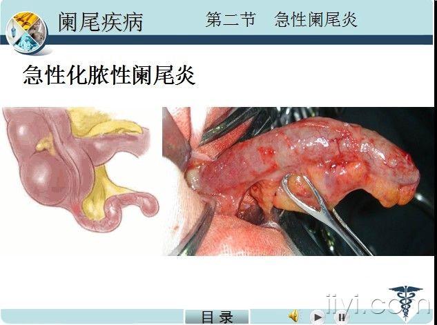 急性化脓性阑尾炎.jpg