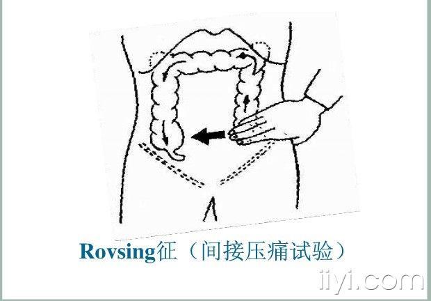 阑尾炎3个压痛点图片