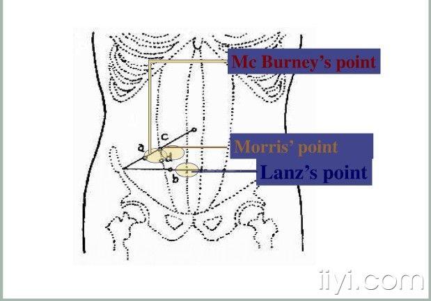 传统的教材上,对急性阑尾炎的局部压痛点的具体位置都进行了