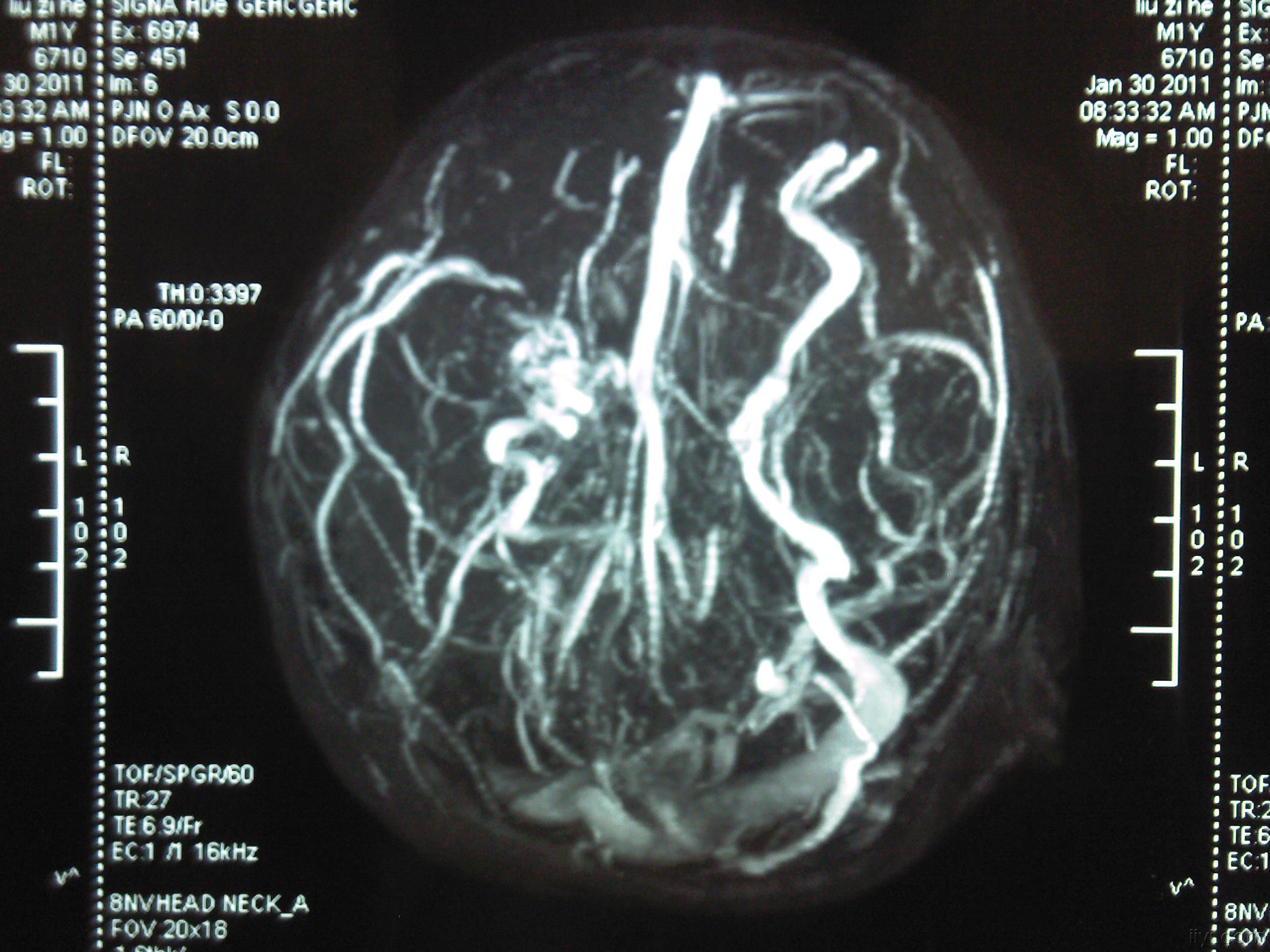 先天性脑血管畸形图片图片