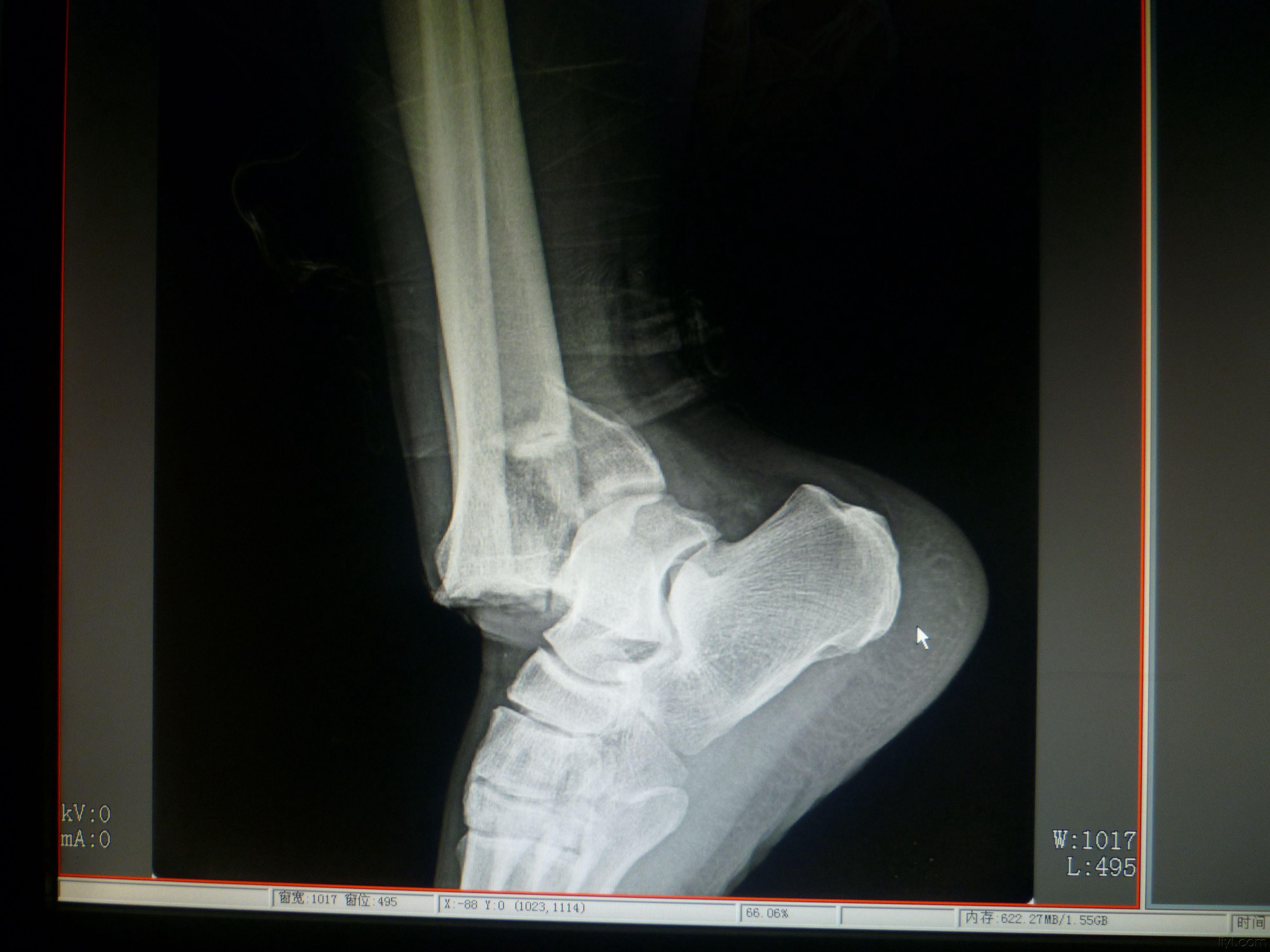 右后踝骨折图片图片