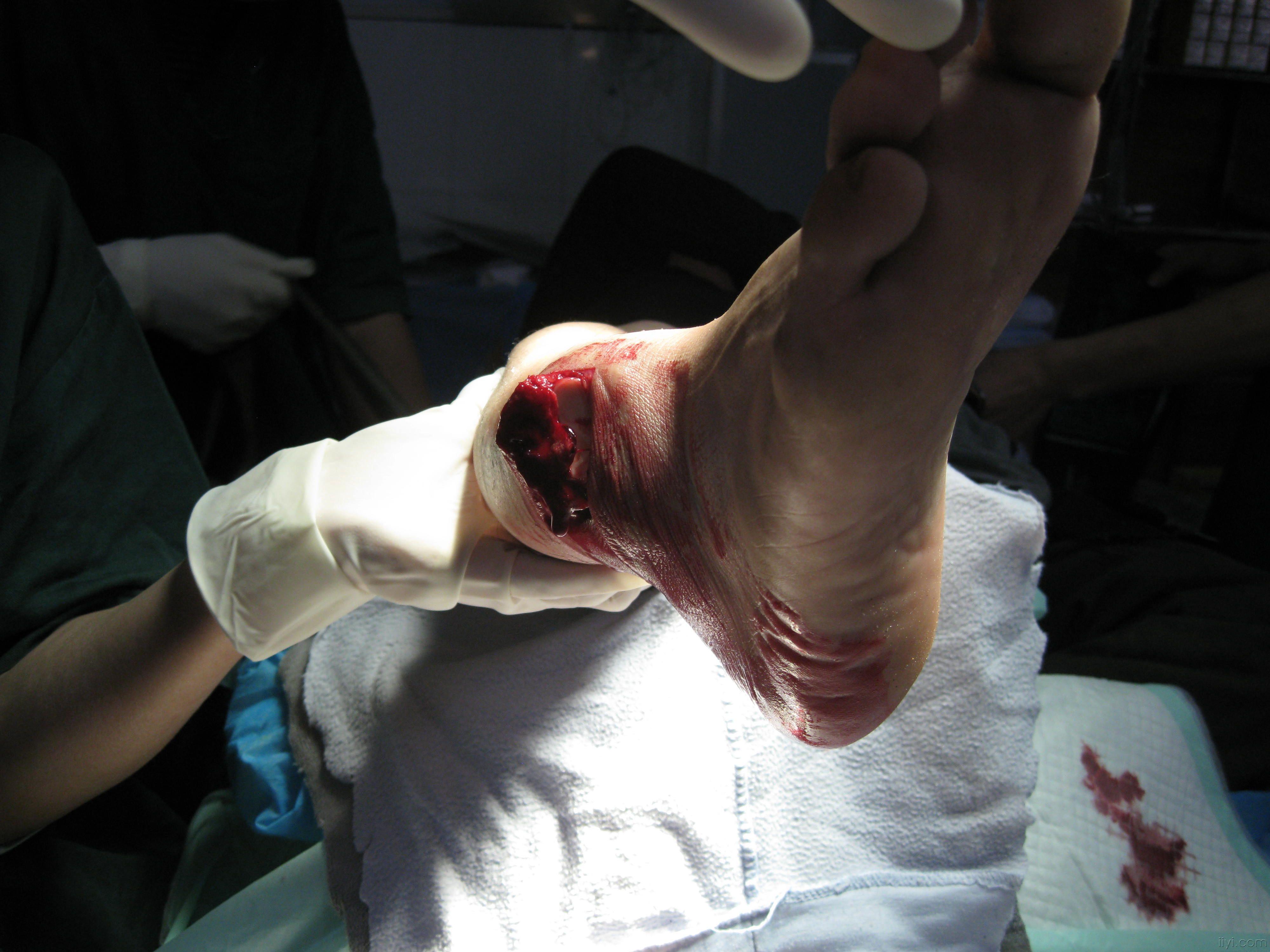 踝关节开放性粉碎性骨折伴脱位