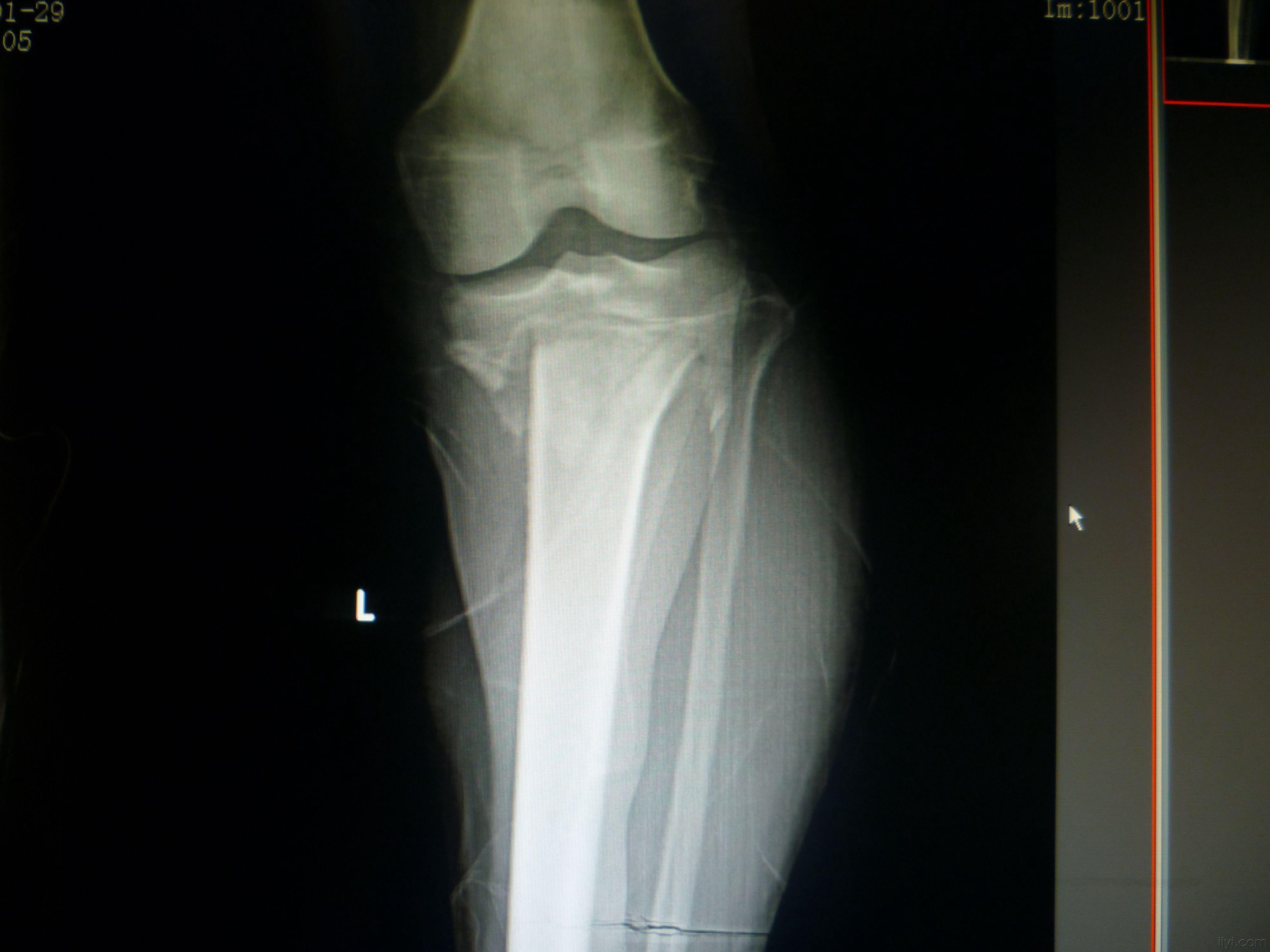 小腿骨折ct照片高清图片
