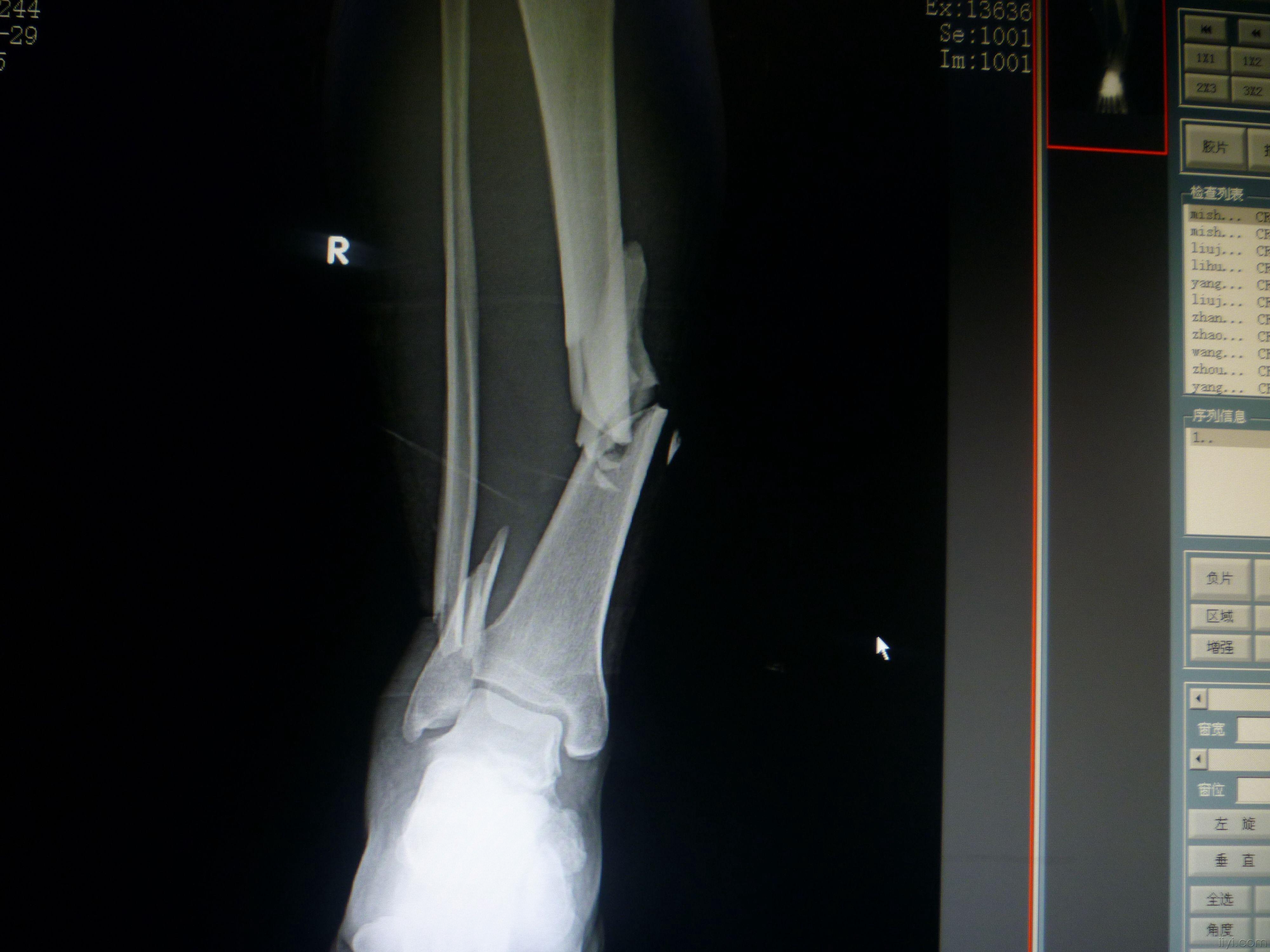 腿骨折的x光照片图片