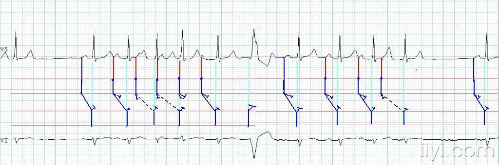 心电图分析这个图是什么请高手分析