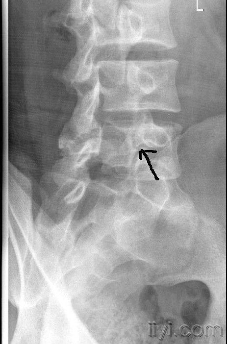 椎弓峡部裂ct诊断图片图片