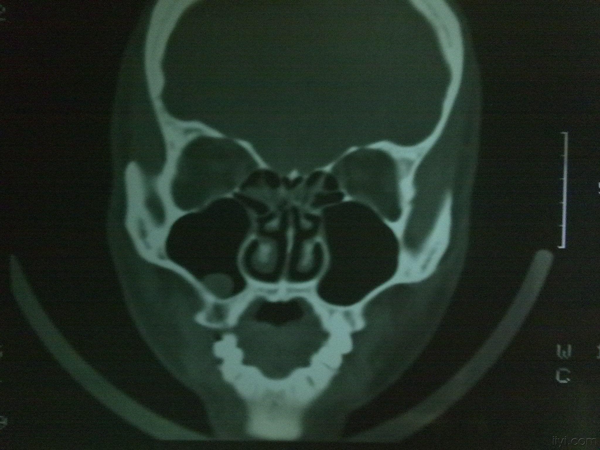 正常上颌窦x线图片图片