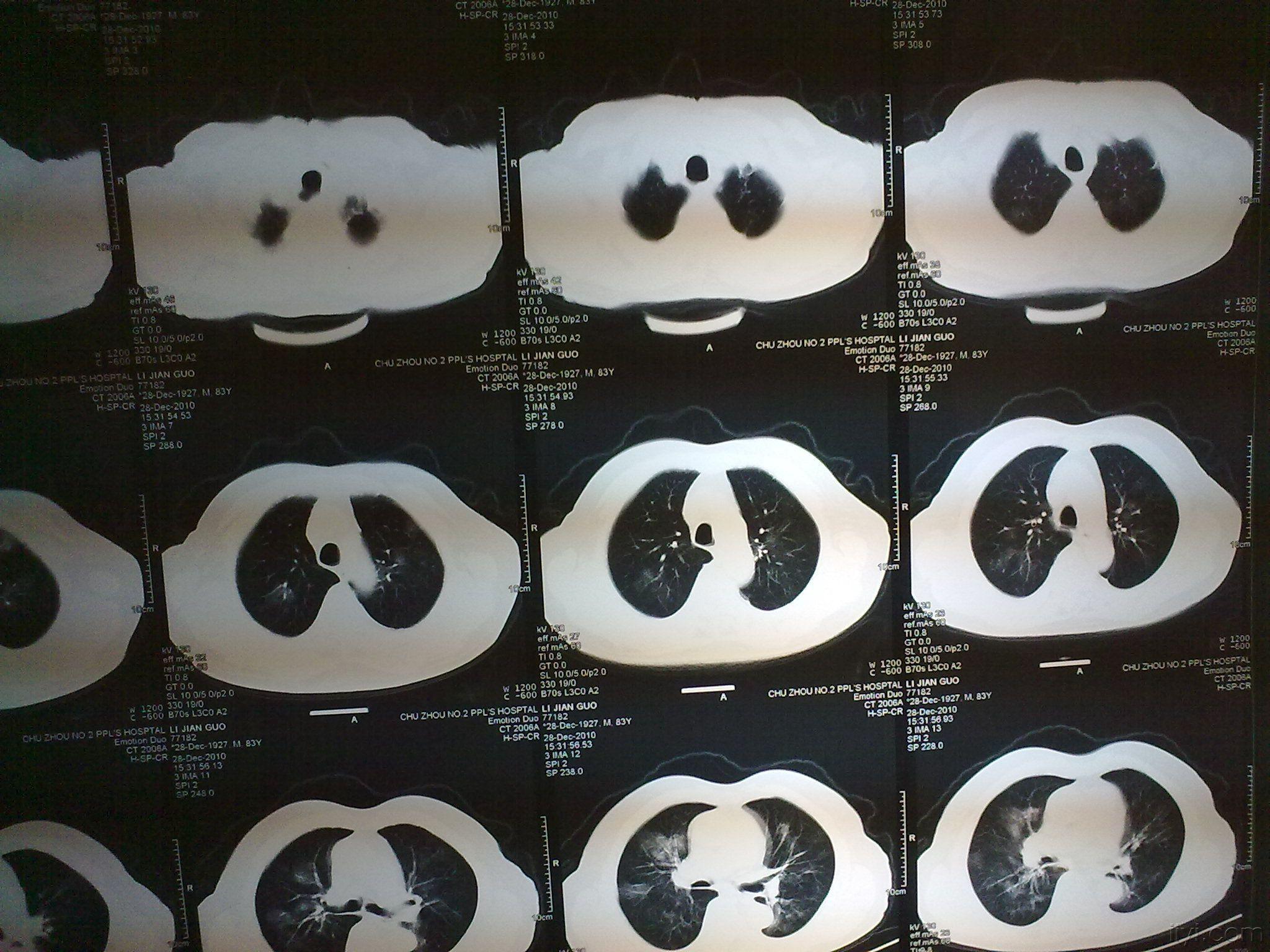 請教胸部ct