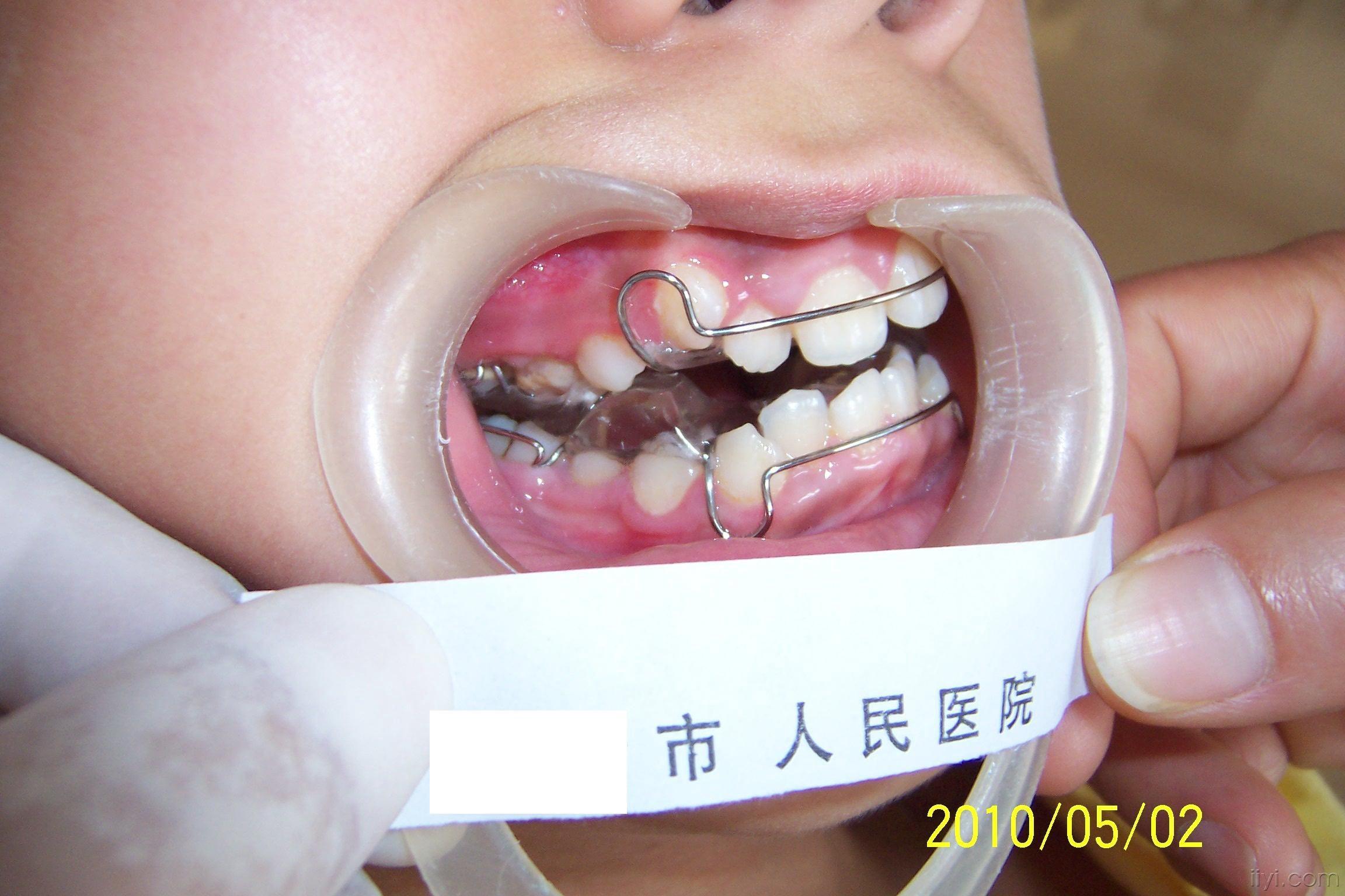 替牙期安ii类twinblock治疗9个月对比照片