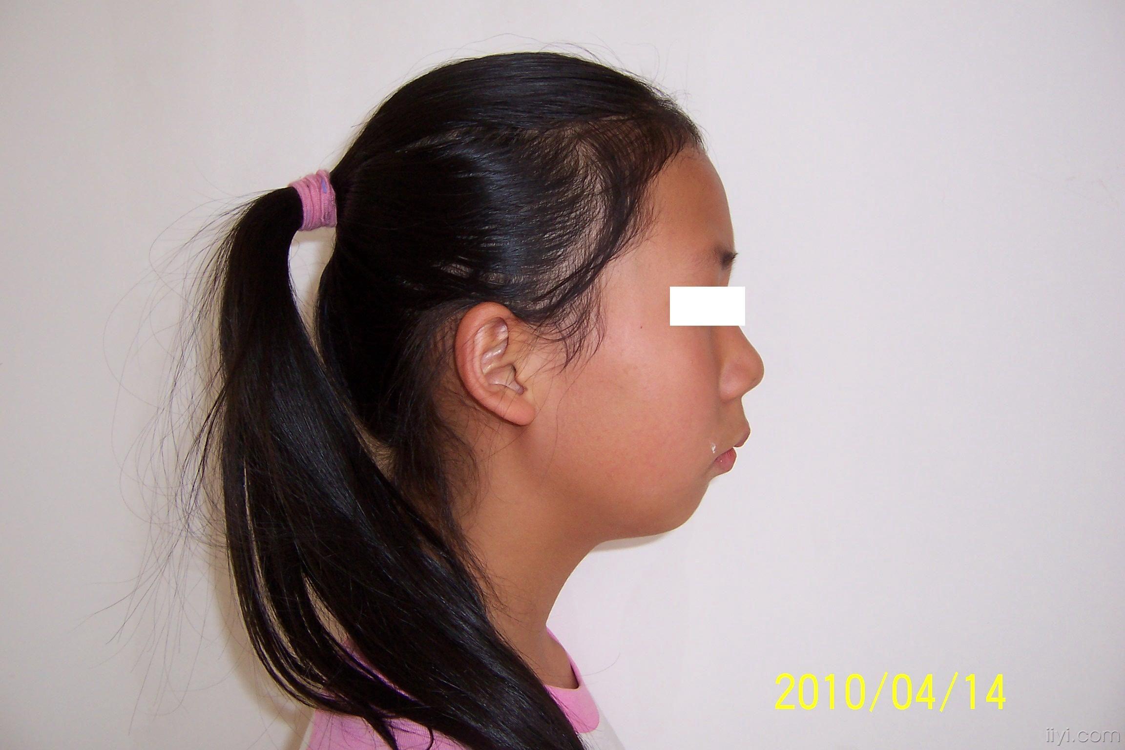 替牙期安ii类,twin-block治疗9个月对比照片 - 口腔医学专业讨论版