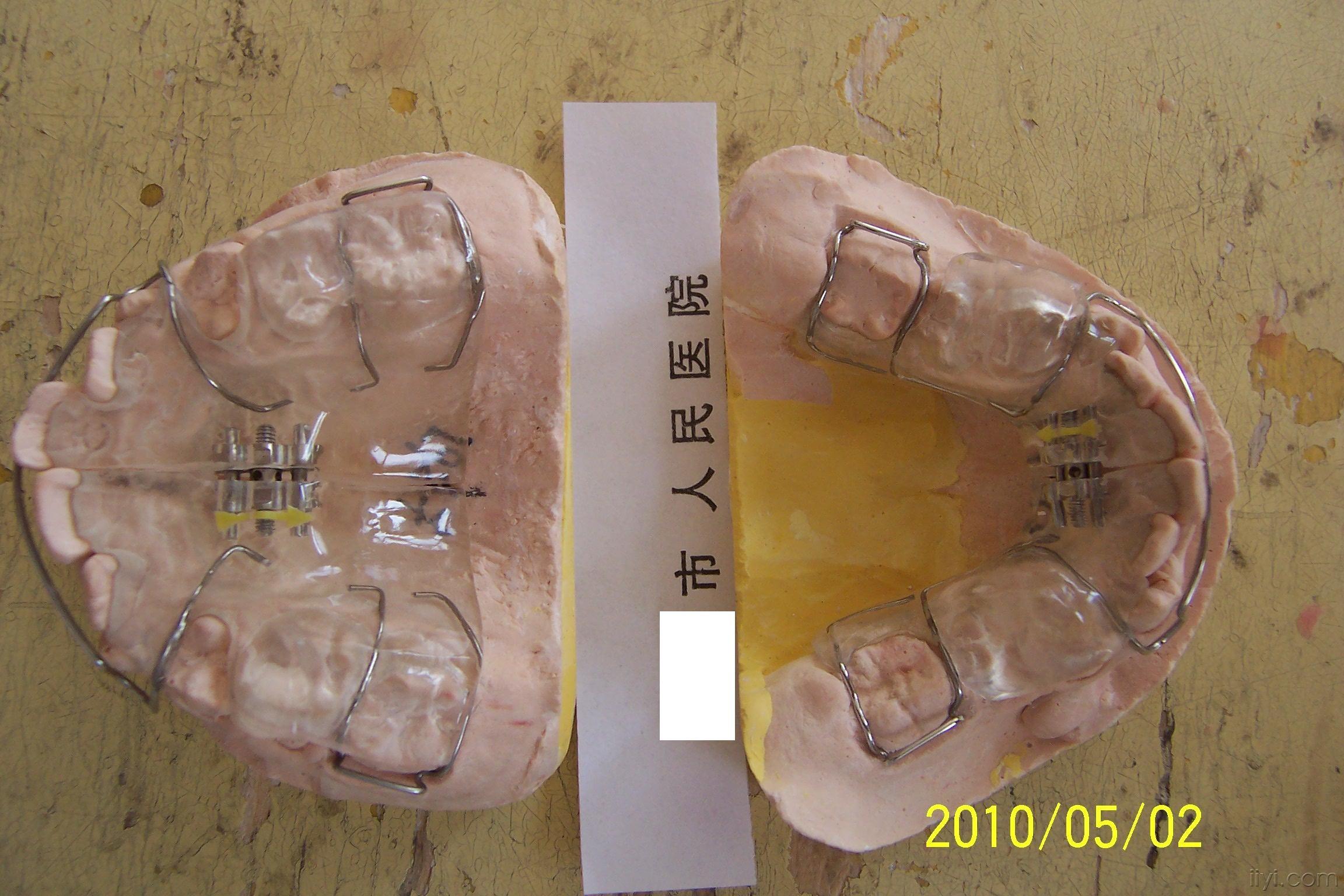 替牙期安ii类twinblock治疗9个月对比照片