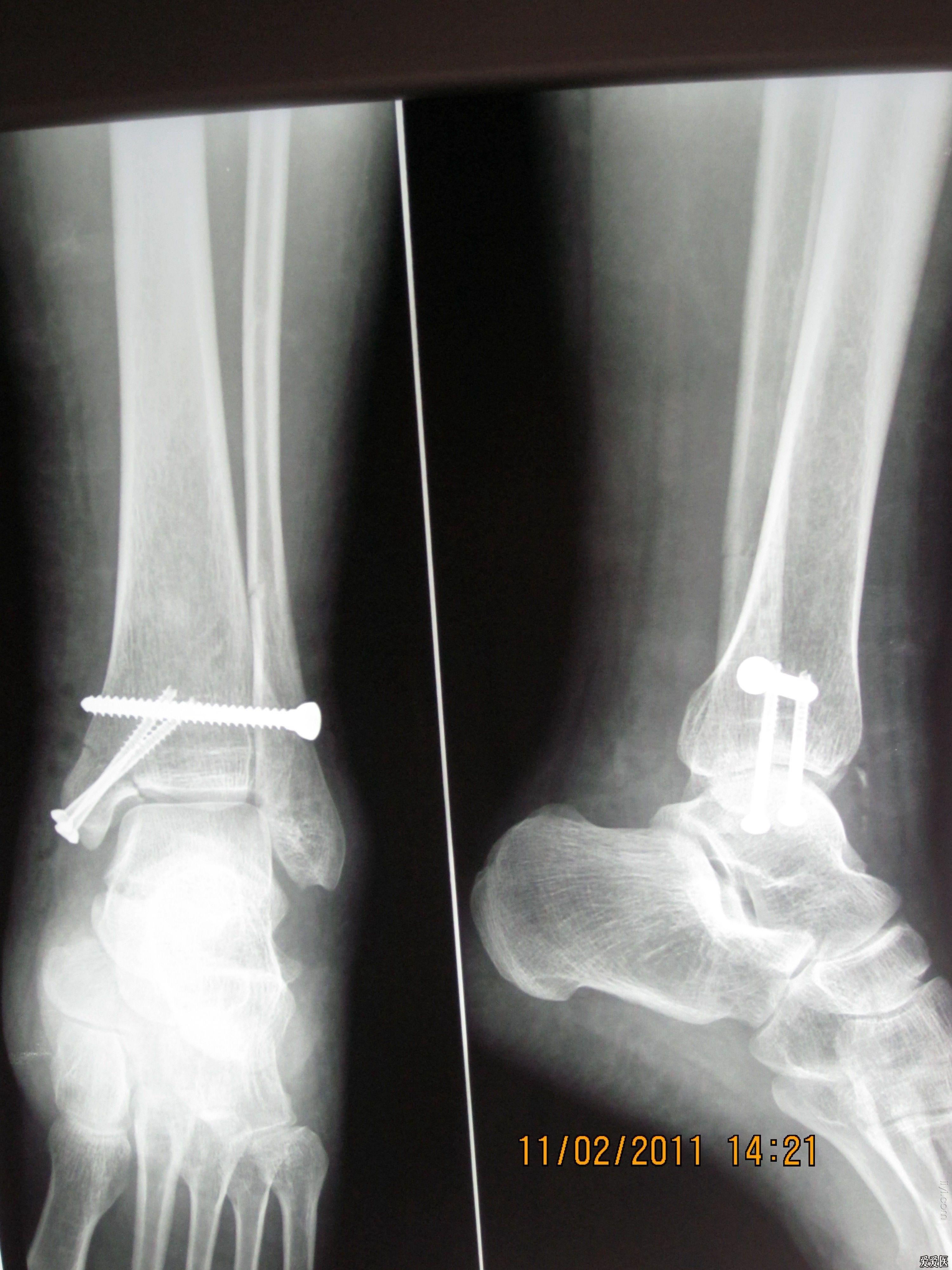 左踝关节骨折(denis