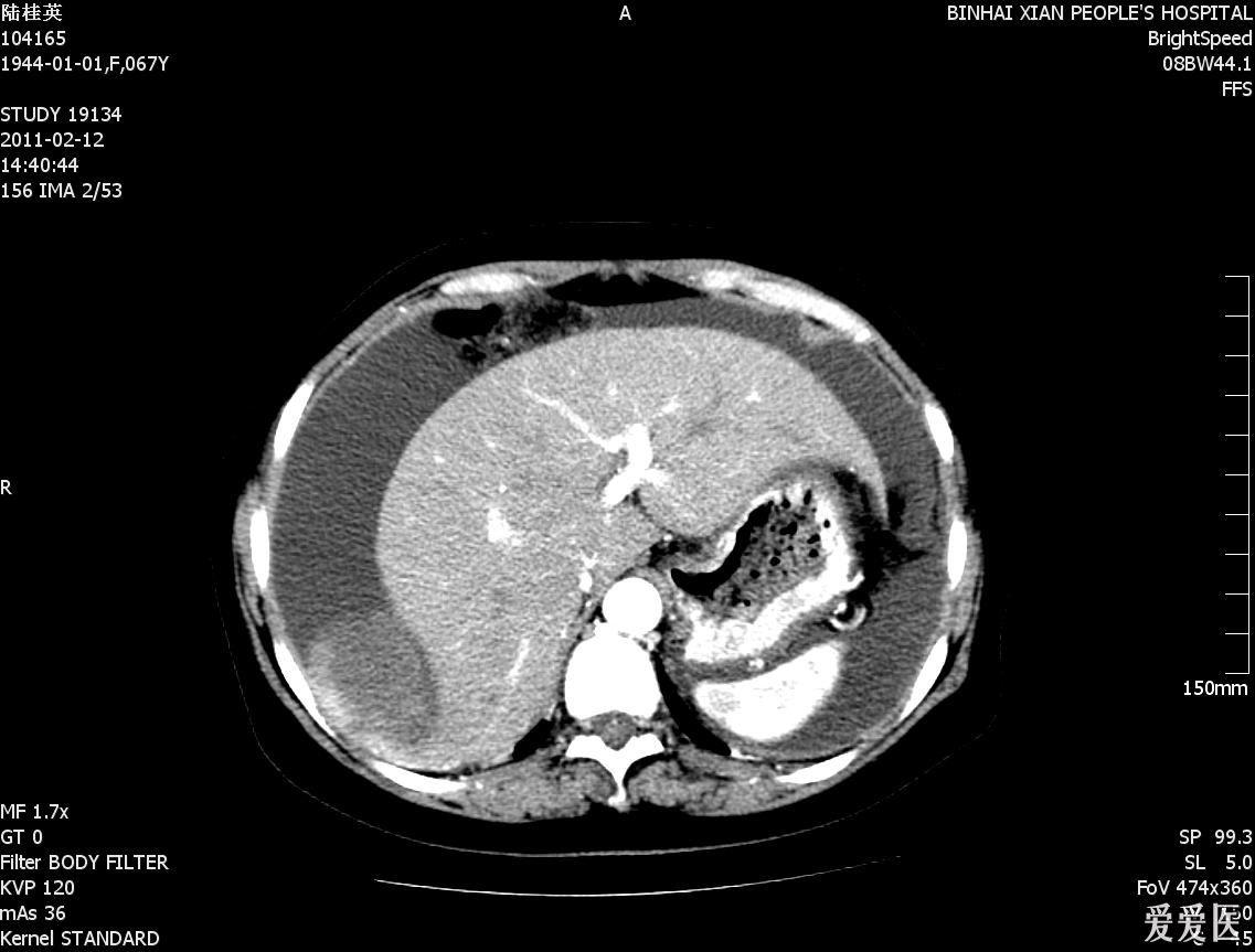 请大家看看哦膈肌肿瘤