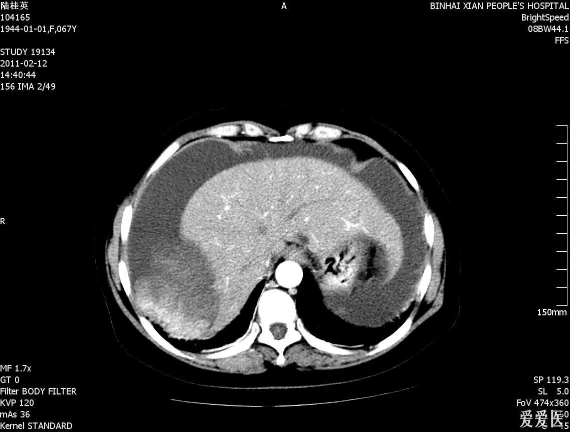 请大家看看哦膈肌肿瘤