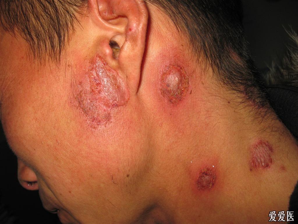 看图识病神经性皮炎