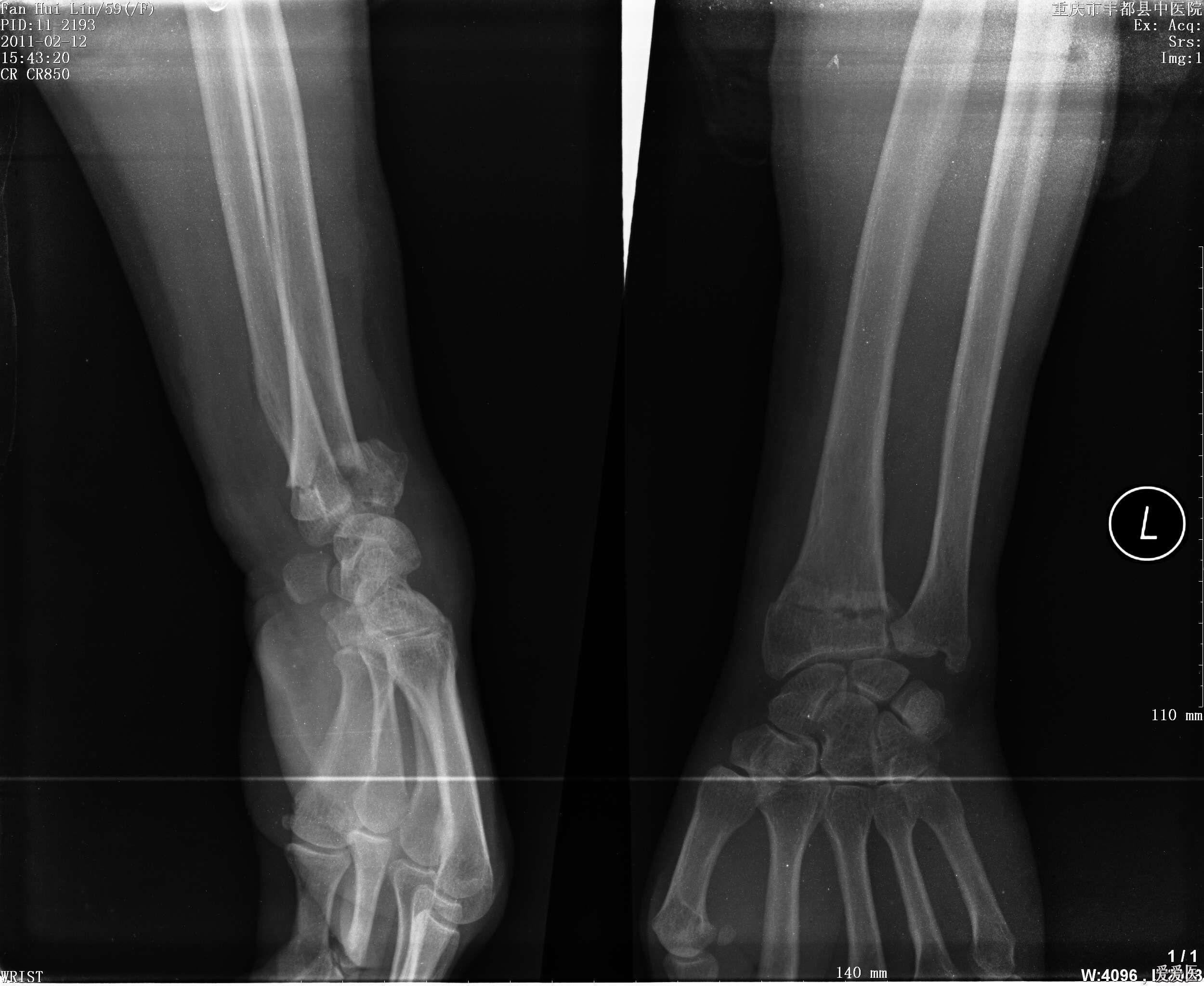 左桡骨下端骨折图片图片