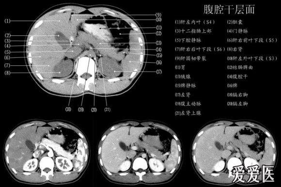 下腹部ct断层解剖图谱图片