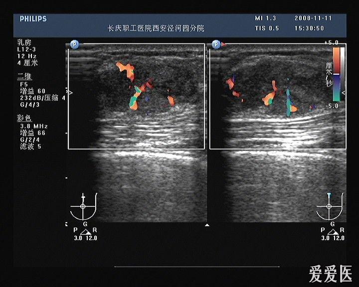 典型病例:乳腺癌 - 超声医学讨论版 - 爱爱医医学论坛